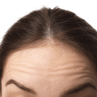 Horizontal forehead lines