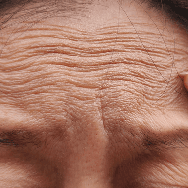 Upper forehead texture