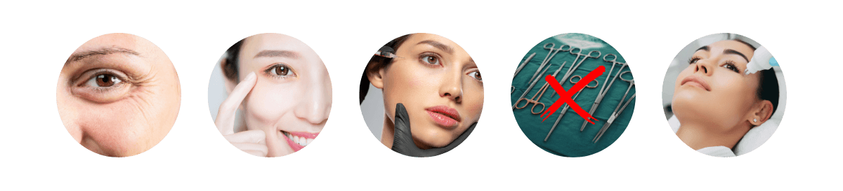 Ideal candidates for crow's feet botox