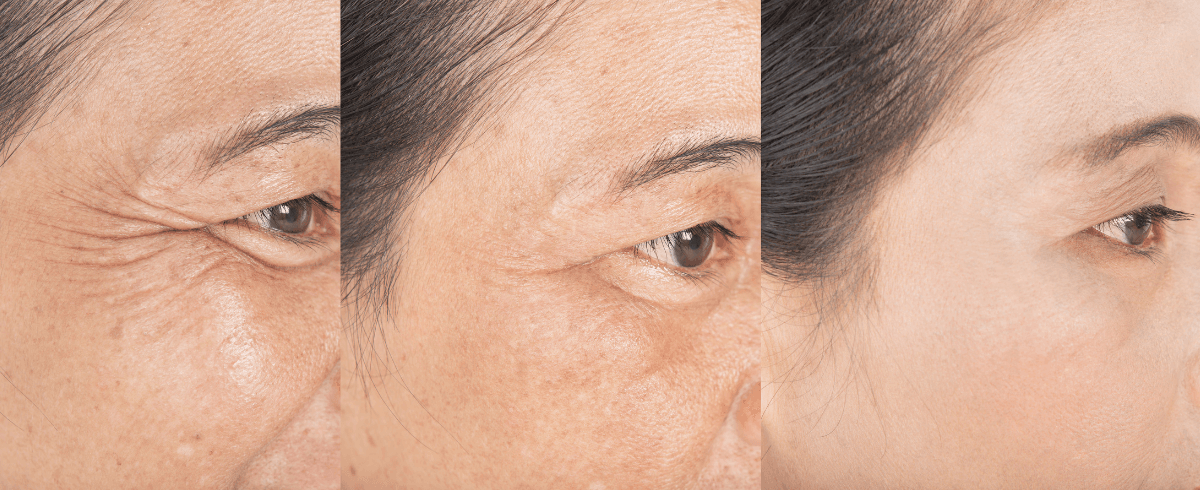 Expected results from crow's feet botox