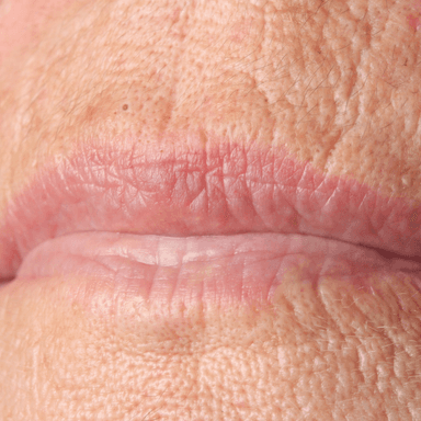 Lip area fine lines