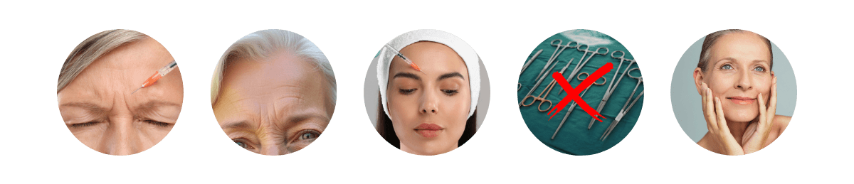 Ideal candidates for frown line botox