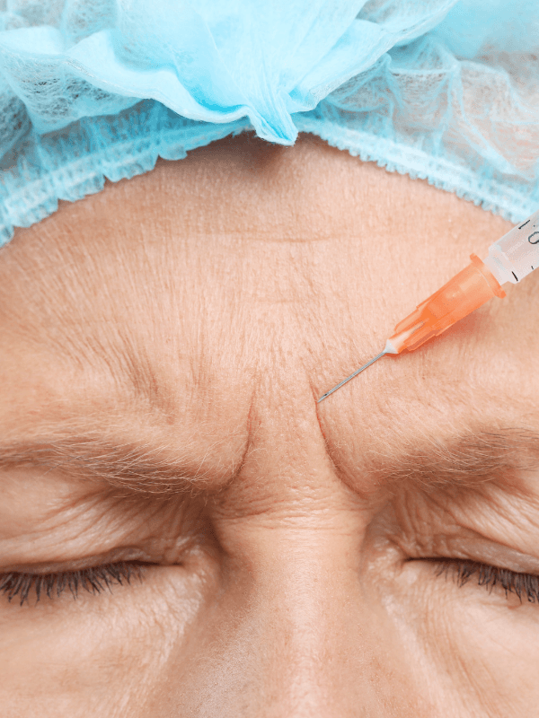 Glabellar frown line injection