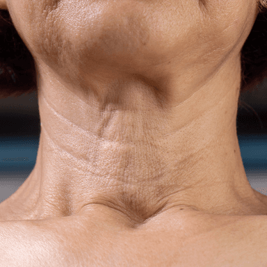 Horizontal neck line softening