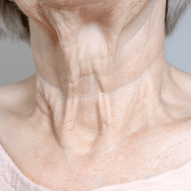 Platysmal band treatment