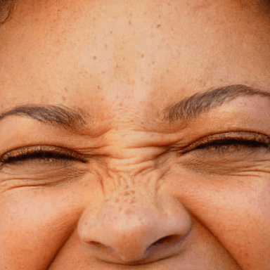 Upper Nose Wrinkles