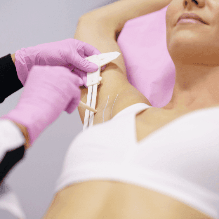 Assessment of the Underarm for Sweating Severity